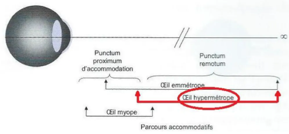 Figure : PPA, PR et parcours accommodatif de l’œil hypermétrope. 