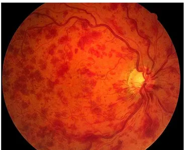 Figure 11 : Cliché d’un fond d’œil présentant une occlusion de la veine centrale de la  rétine avec de nombreuses hémorragies rétiniennes