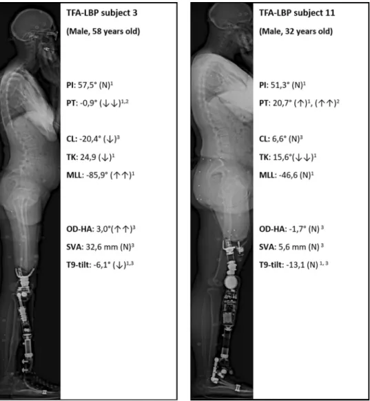 Fig. 2    Lateral radiograph of  the full spine in two TFA-LBP  subjects (subnormal values have  one arrow; abnormal values  have two arrows and normal  values have a “N”)