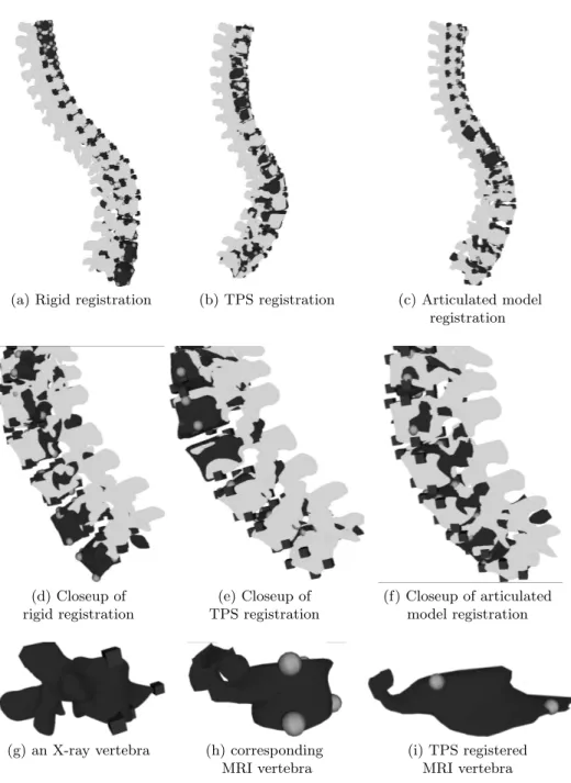 Fig. 3. Registration between vertebrae extracted from MRI (dark grey) and X-ray data (light grey)