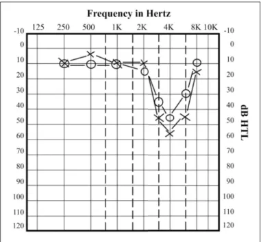 Figure 1.1 Audiogram showing a severe music-induced or noise-induced hearing loss, where a notch in sensitivity is apparent around 4 kHz (O = Left ear, X = Right Ear)
