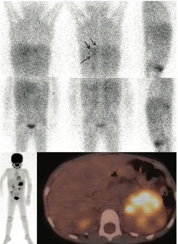 Fig. 13. Enfant de 6 ans présentant un neuroblastome surrénalien gauche découvert  lors d’un bilan d’hypertension artérielle