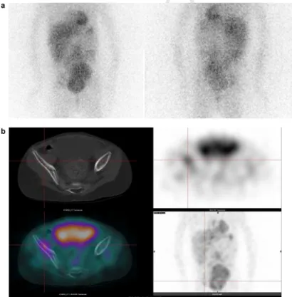 Fig. 2. Scintigraphie à la 123 I-MIBG chez un enfant présentant un neuroblastome stade 4 : a : foyer de fixation de l’aile iliaque droite équivoque sur les acquisitions planaires en raison de l’activité vésicale intense à proximité ; b : lésion osseuse de 