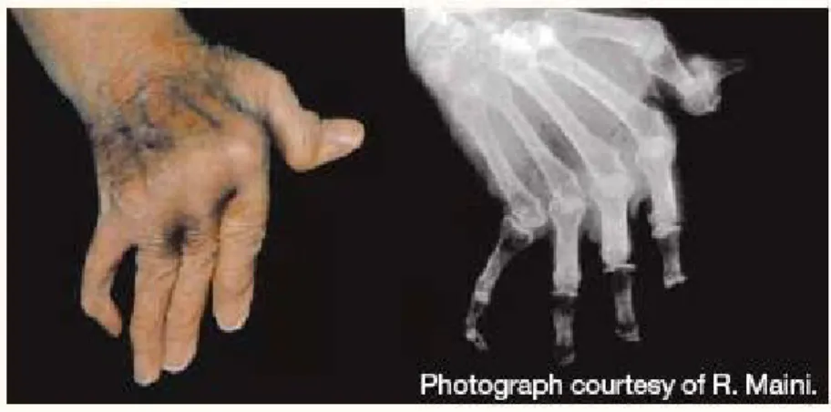 Figure  4 :  Effet  de  la  polyarthrite  rhumatoïde  sur  les  mains :  radiographie des déformations d’une main rhumatoïde [25]