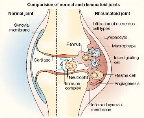 Figure 8: Comparaison de l’articulation normale et l’articulation  rhumatoïde [25] 