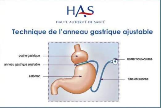 Figure 1 : anneau gastrique ajustable d’après « Obésité : prise en charge chirurgicale chez l'adulte », recommandation de  bonne pratique HAS 2009 
