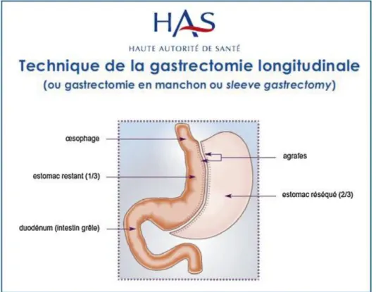 Figure 2 : gastrectomie en gouttière d’après « Obésité : prise en charge chirurgicale chez l'adulte », recommandation de  bonne pratique HAS 2009