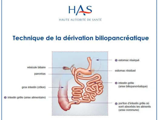 Figure 5 : dérivation biliopancréatique d’après « Obésité : prise en charge chirurgicale chez l'adulte », recommandation de  bonne pratique HAS 2009