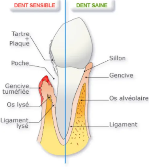 Figure 1 - Schématisation de l'atteinte parodontale (https://www.papilli.fr/numero-de- (https://www.papilli.fr/numero-de-brossette-interdentaire-papilli-dents/) 