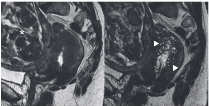 Figure 2 MRI before and after UPA treatment. 