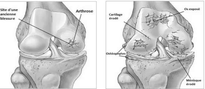 Figure 1.12 L'arthrose du genou : De la lésion légère (a) à l'atteinte globale (b)  Images tirées et adaptées du site  : http://www.centerpulseorthopedics.com/eprise/main/ 