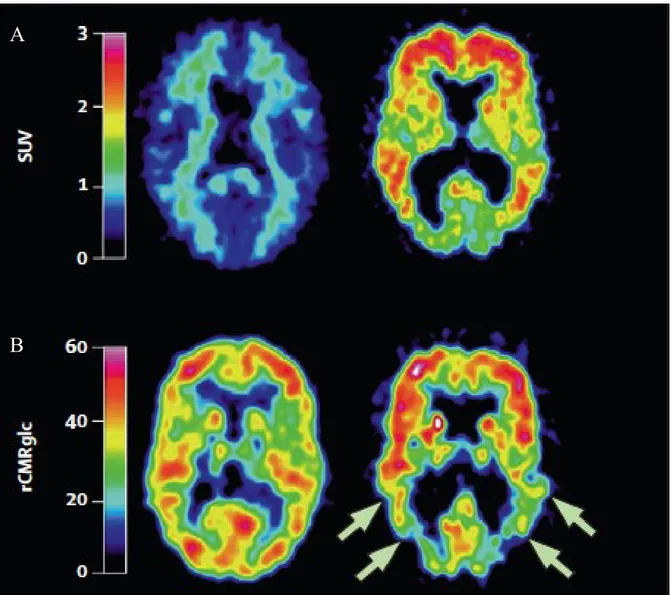Figure  1-3.  Comparaison  de  la  rétention  du  PIB et du métabolisme de glucose  dans un  cerveau  normal  et  un  cerveau  de  patient  atteint  de  la  MA
