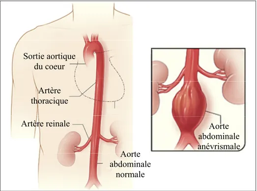 Figure 1.1   Représentation d'un anévrisme de l'aorte abdominale  Adaptée du site internet du National Institutes of Health : 