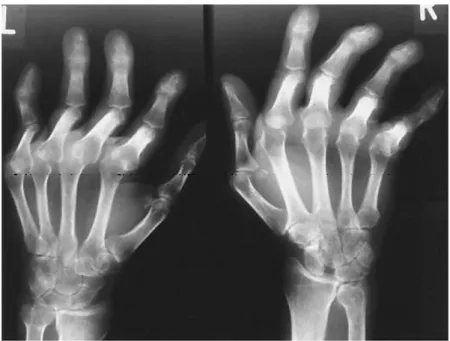 Figure 9 : Radiographies de mains d’un rhumatisme de Jaccoud.  (Pipili et coll. 2008) 