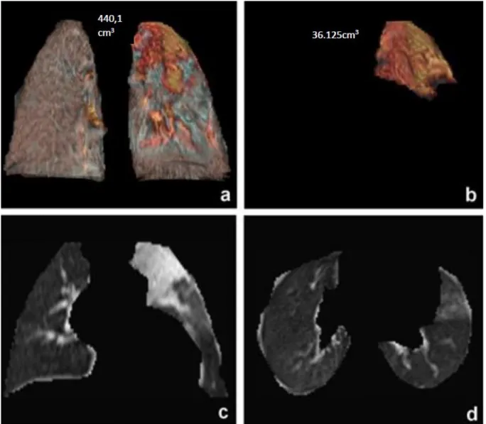 Figure  1  Exemple  d'analyse  d'image  IRM.  Après  délimitation  manuelle  des  contours  pulmonaires,  le  logiciel  GE  Viewer  reconstruit automatiquement en 3D et calcule le volume pulmonaire total (image a)