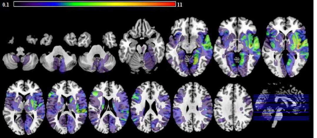 Figure 2: Axial slices showing lesion overlapping map of 59 patients. Purple colour indicates the least number of overlap and red colour indicates the  highest overlap