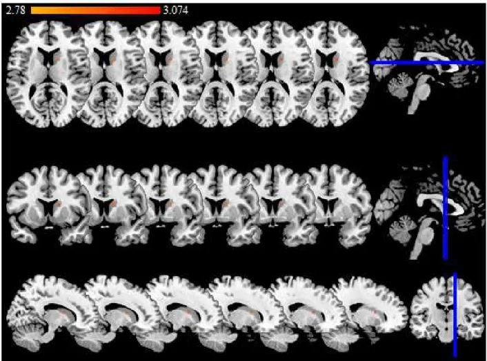 Figure 4: Significant lesion associated with PSD (BDI-FS ≥ 4). The color scale indicates the Z  score