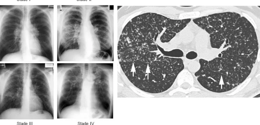 Figure 7 : Radiographie et tomodensitométrie thoracique illustrant les quatre stades d'atteinte  pulmonaire