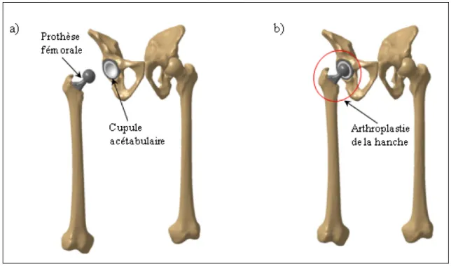 Figure 1.3  a) Composantes de l'arthroplastie de la hanche b) Résultat de  l'arthroplastie de la hanche 