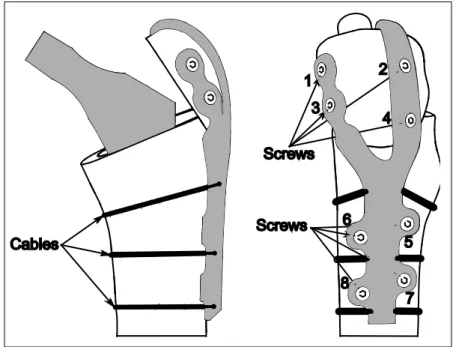 Figure 3.1  Y3Greater Trochanteric Reattachement System 