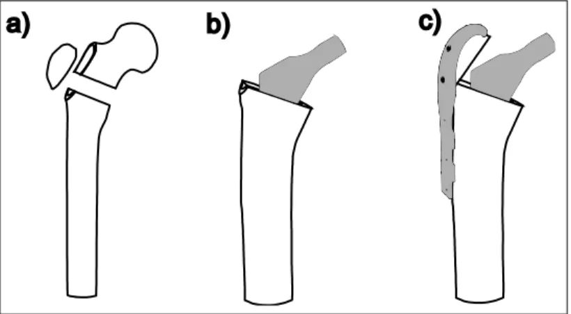 Figure 3.2  CAD modeling steps of the GTR and Femur assembly: 