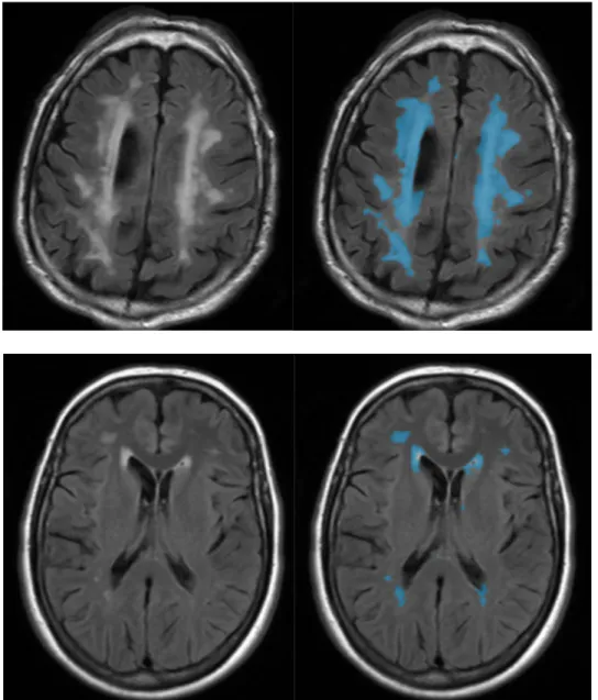 Figure 1 : White matter hyperintensities segmentation with Pixyl.neuro – Left Slices correspond to native images; On  right slices, blue masks correspond to automated segmentation