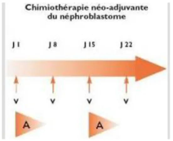 Figure 1. Chimiothérapie néo adjuvante du néphroblastome  A : Actinomycine = 45 µg / kg  V: Vincristine = 1,5 mg/m2