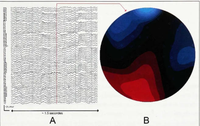 Figure 1.2 Exemple d'enregistrement EEG (A) et topographie correspondante (B) [1]. 