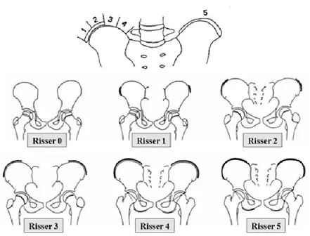 Illustration 3 : Stades de RISSER 