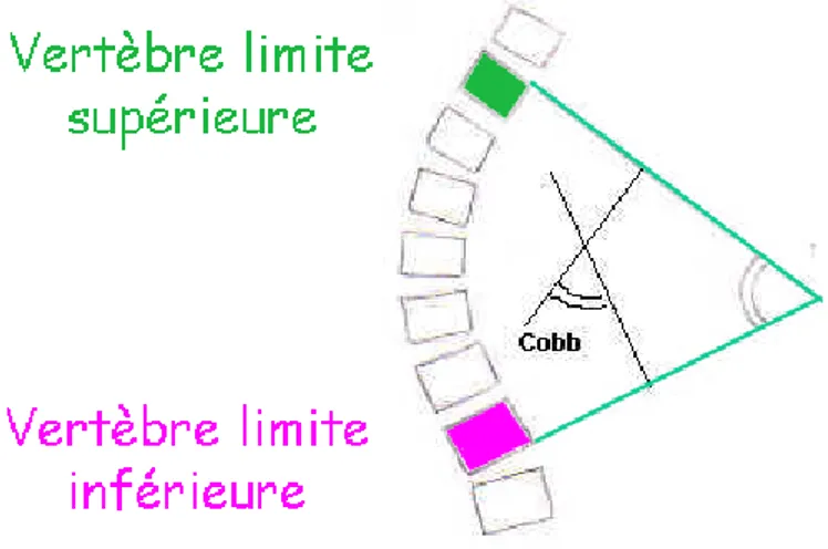 Illustration 4 : Mesure de l’angle de COBB 