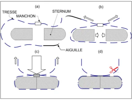 Figure 2.6  Installation du SDF superélastique en quatre étapes en vue de coupe  transverse : (a) passage de la tresse autour du sternum; (b) application d’une consigne 