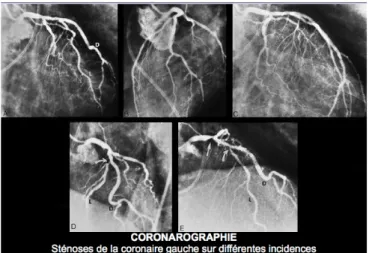 Figure R Exemple de coronarographie 