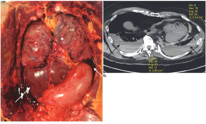 Figure 1. (a) Homme de 45 ans décédé en glissant et chutant de son scooter: l’autopsie  révèle la présence d’un hémothorax bilatéral (flèches)