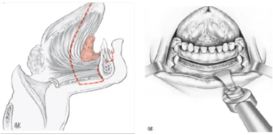 Figure 15 : Pelvi-glosso-mandibulectomie non-interruptrice (Marandas et al., 2006 dans  EMC) 