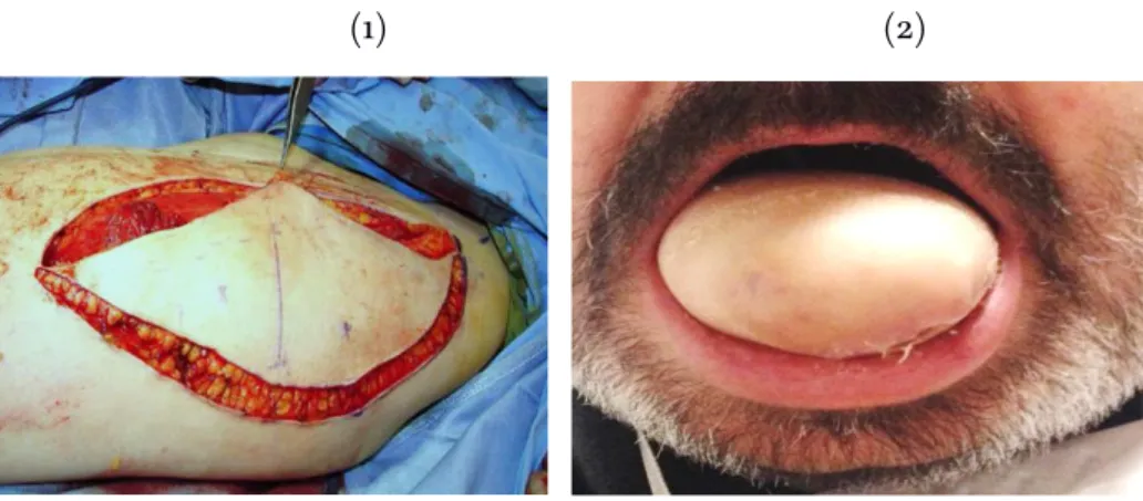Figure 20 : (1) Lambeau antérolatéral de la cuisse (Fagan, 2014) (2) Reconstruction avec un  lambeau antérolatéral de la cuisse après une pelviglossectomie totale non-interruptrice 