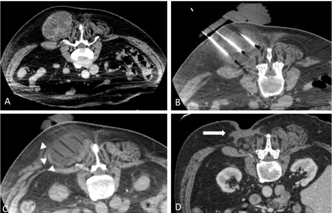 Figure 2 CT image of a soft-tissue paravertebral metastasis of a grade 3 pleomorphic liposarcoma in a 73-year-old men, before  procedure (A), perprocedure showing cryoprobes within the lesion (B)