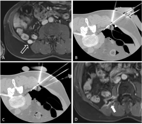 Figure  3  Local  relapse  of  a  grade  2  retroperitoneal  liposarcoma  in  a  63-year-old  men:  MR  imaging  after  enhancement showing the local relapse as a  nodular enhancement in the retroperitoneal primary site (A, empty  arrow), treated by CT-gui