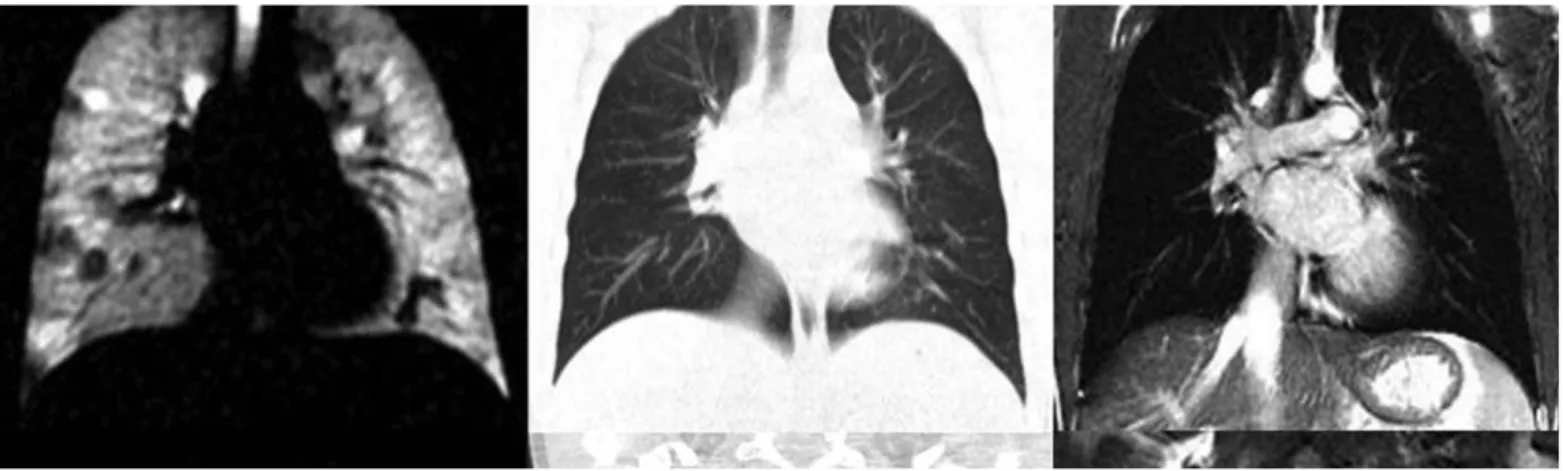 Figure  9.  Exemple  de  discordance  entre  l’IRM  ventilatoire  par  gaz  hyperpolarisé  ( 3 He)  (A)  avec  les  données  morphologiques obtenues en scanner (B) et en IRM conventionnelle (C) chez un patient atteint de mucoviscidose à un  stade  précoce 