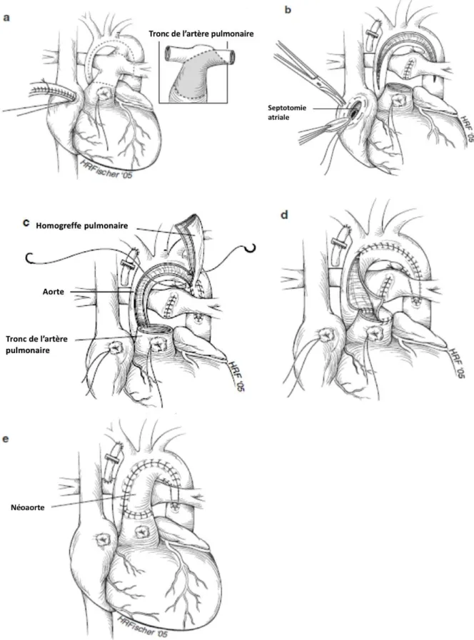 Figure 2 : Intervention de Norwood : intervention de Damus-Kaye-Stansel avec shunt de Blalock-Taussig (4) 