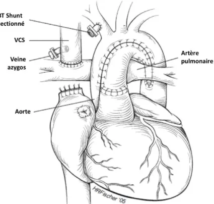 Figure 4 : Dérivation cavo-pulmonaire partielle (Glenn) (4) 