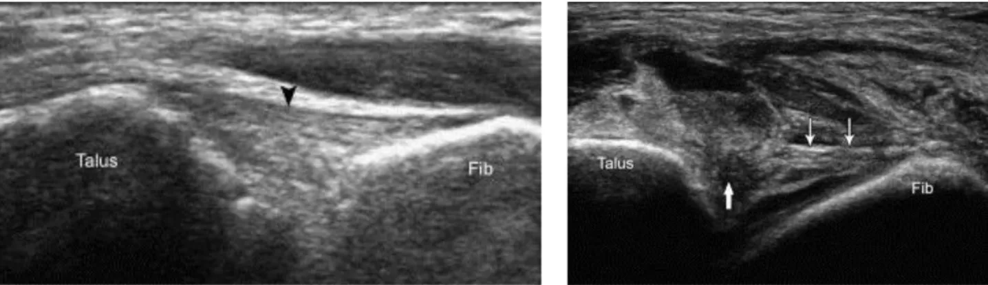 Figure 4 : Échographie ligamentaire avec un ligament talo-fibulaire antérieur sain (gauche) et rompu (droite) 