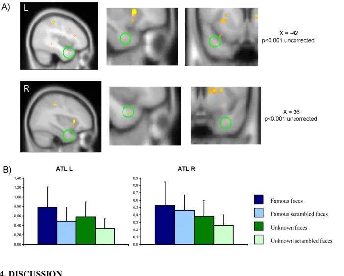 Figure 3. Patterns of activation in the (FF - FSF) - (UF - USF) contrast. A. Functional  results were superimposed to a T1 canonical template in sagittal and coronal planes and  anatomical localization was based on visual inspection of the data with refere