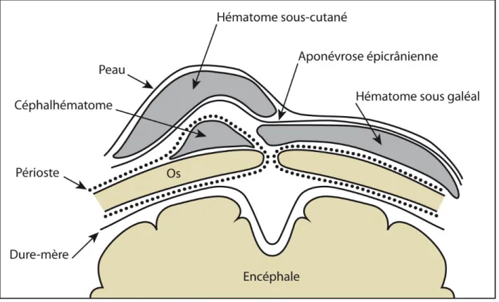 Figure 4 - Localisation des différents hématomes du scalp 