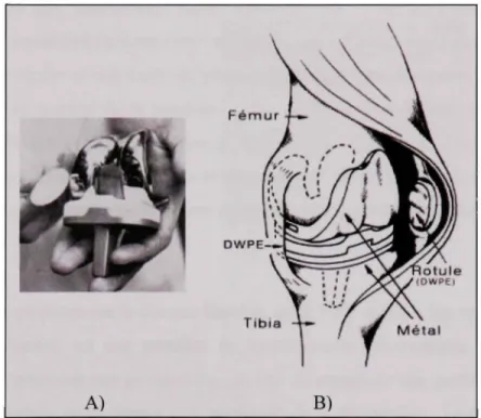 Figure 1.1 Prothès e totale.  University of lowa (1983) 