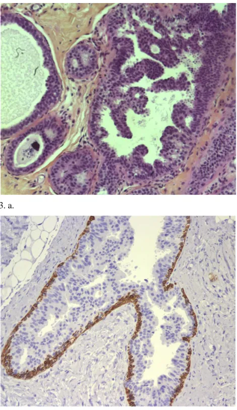 Figure 3. Hyperplasie canalaire atypique (HCA) 