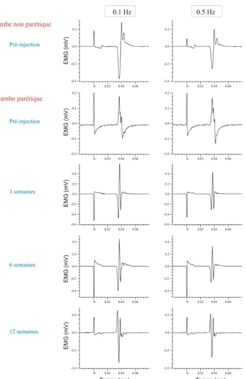 Figure 9 : Exemple d’enregistrements électromyographies réalisés chez un patient (patient 5)  avant et après injection intramusculaire de toxine botulique 