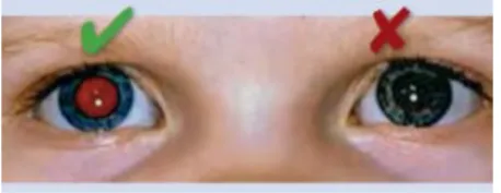 Figure 4 : Asymétrie des reflets pupillaire d’après d’après Community Eye Healt (6) 