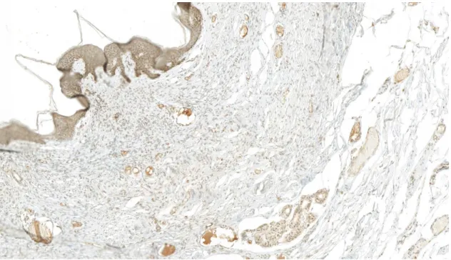 Tableau 6 : Résultats d’IHC de catK et d’HMGA-2 pour les variantes histologiques rares des  HCF