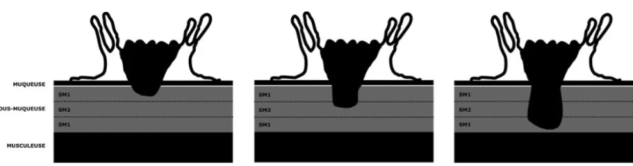 Figure 11: Classification de Kikuchi. Classification des cancers superficiels du côlon et du rectum  (T1) en fonction de la profondeur du front d’invasion 