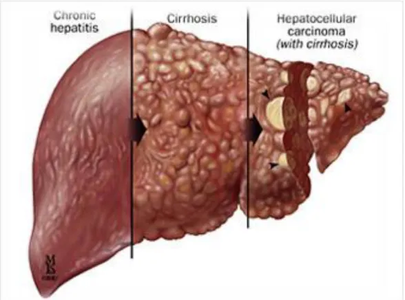 Figure 6 : Evolution de la fibrose hépatique 
